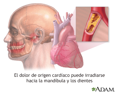 ataque cardiaco simulacrum